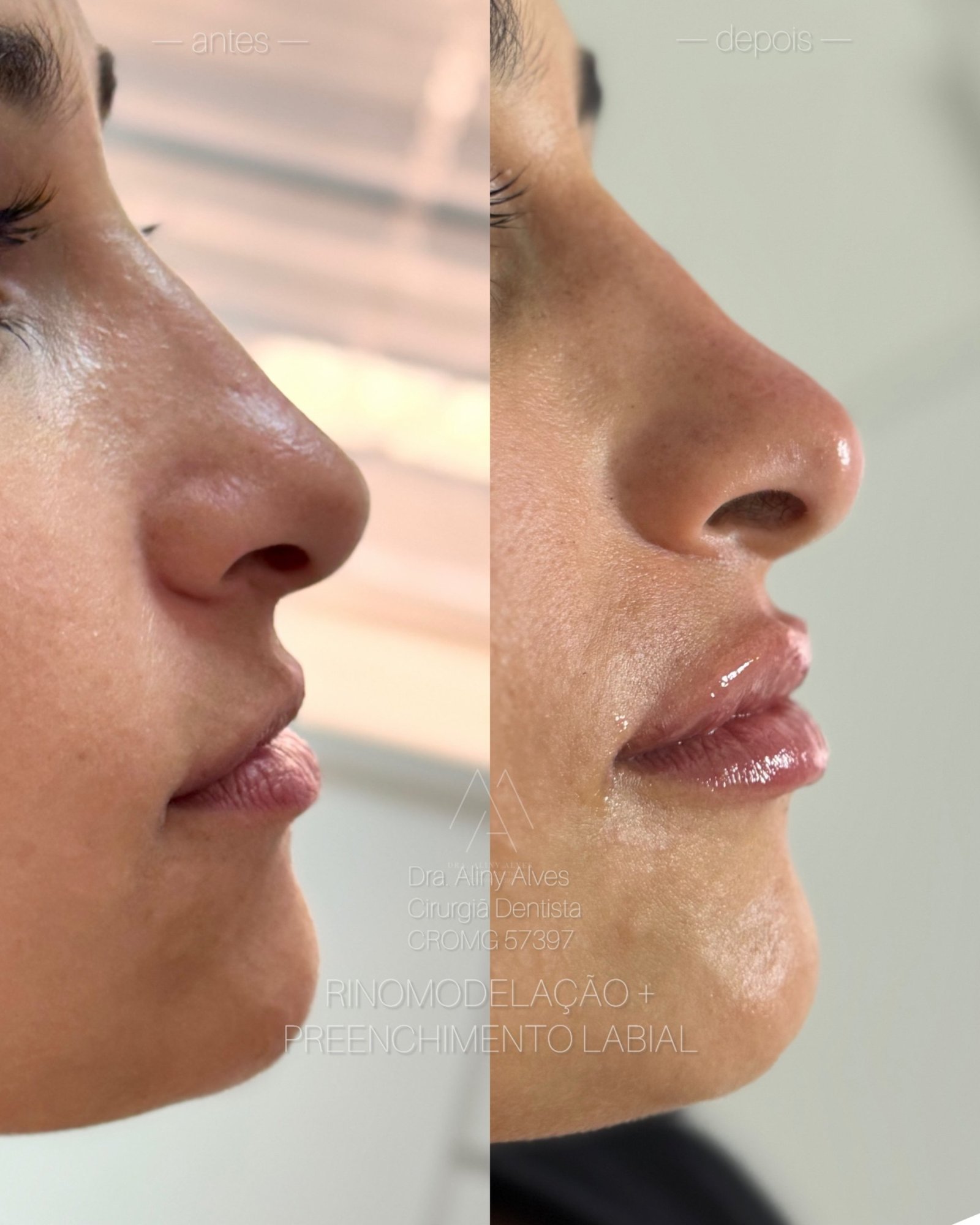 Rinomodelação e preenchimento labial