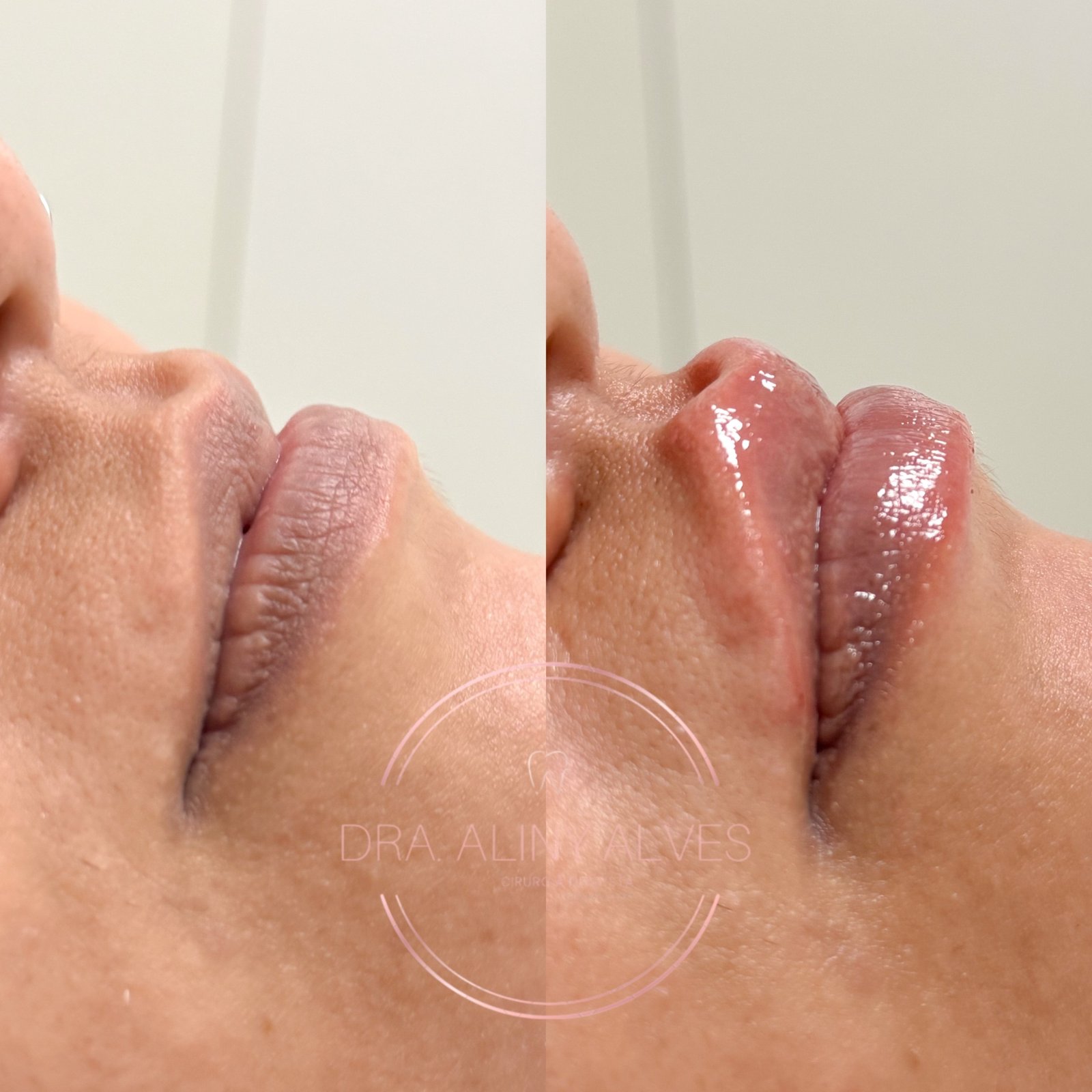 Foto do trabalho de Doutora Aliny Alves — Dentista