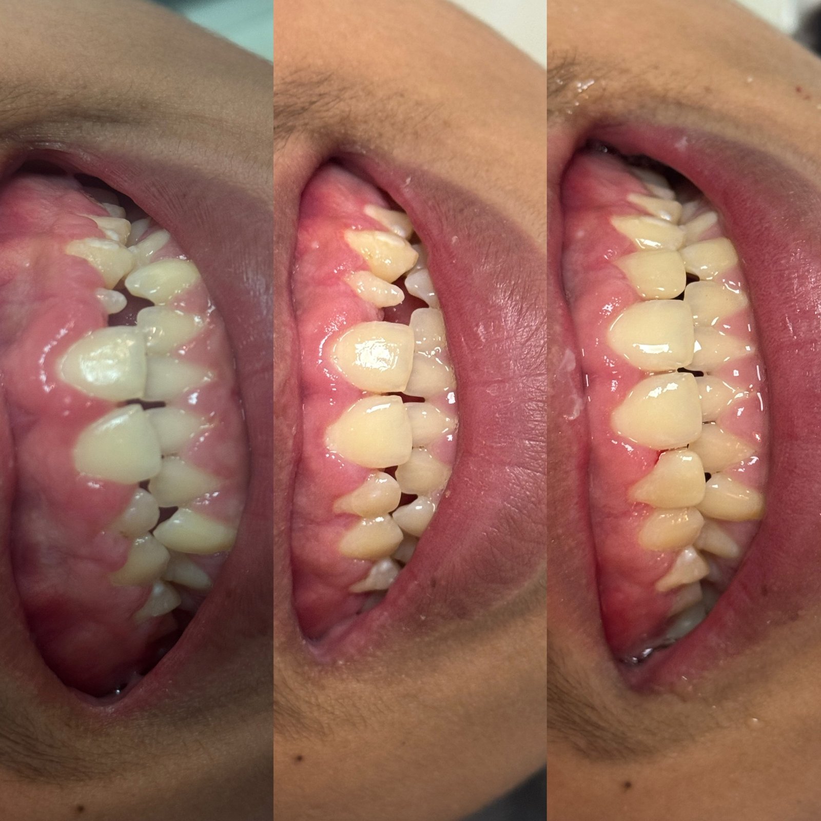 Gengivoplastia e reanatomização de elementos