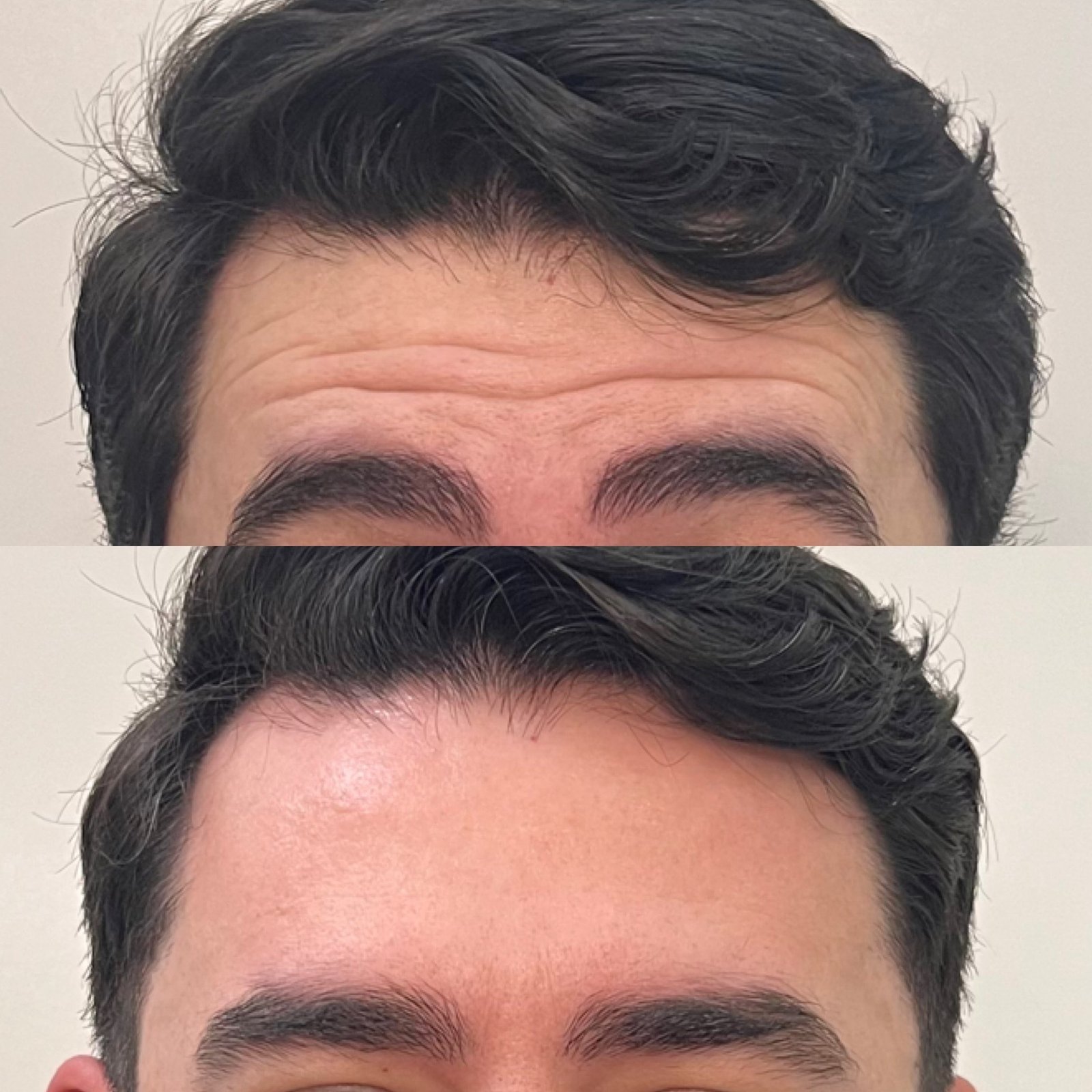 A toxina botulínica masculina suaviza as linhas de expressão, mantendo a naturalidade e respeitando os traços e a identidade do rosto masculino.