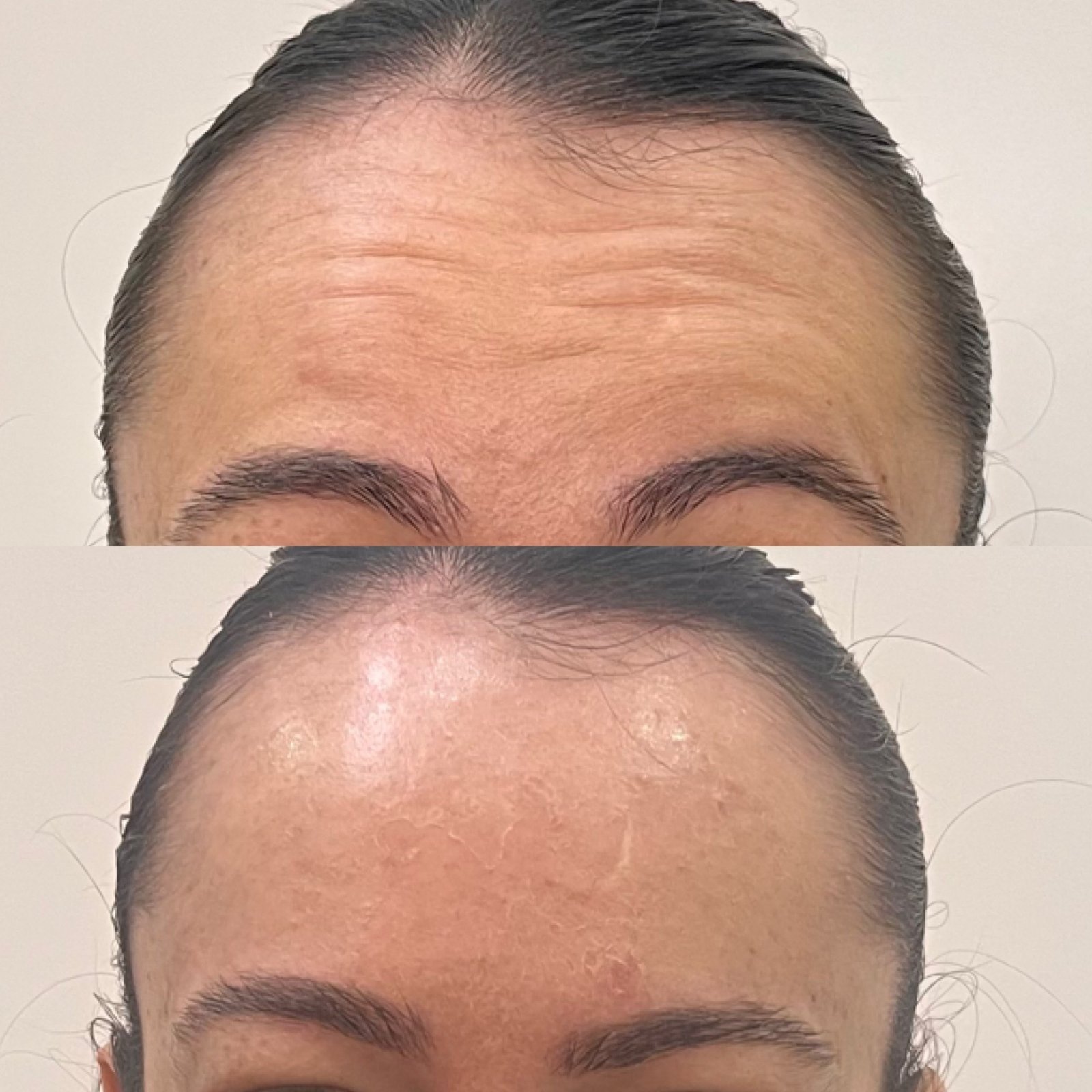 Suaviza as linhas de expressão, prevenindo marcas profundas e proporcionando uma aparência mais leve e natural, respeitando cada rosto.