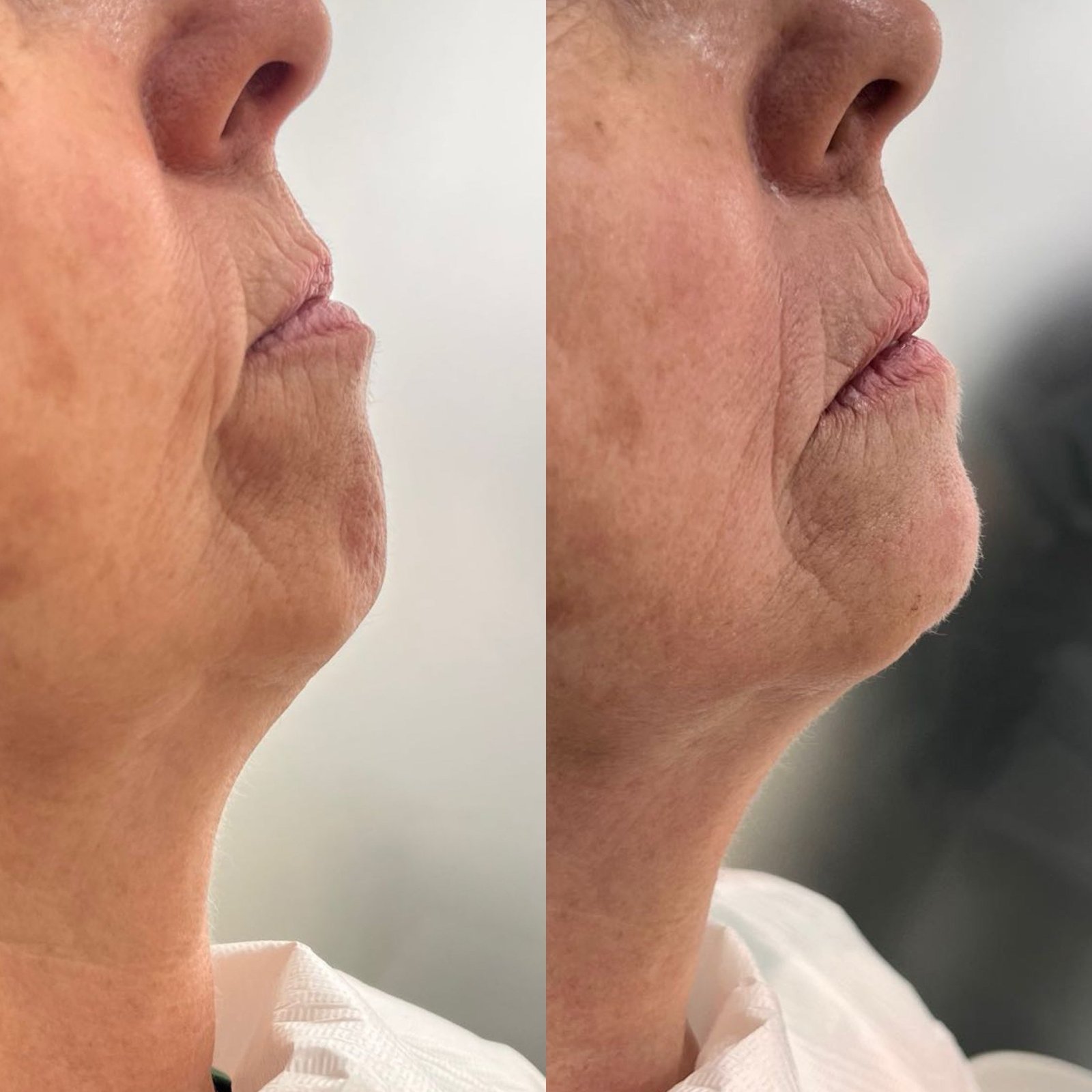 Melhora a projeção do queixo e contribui para o equilíbrio do perfil facial, valorizando a harmonia e os contornos do rosto.