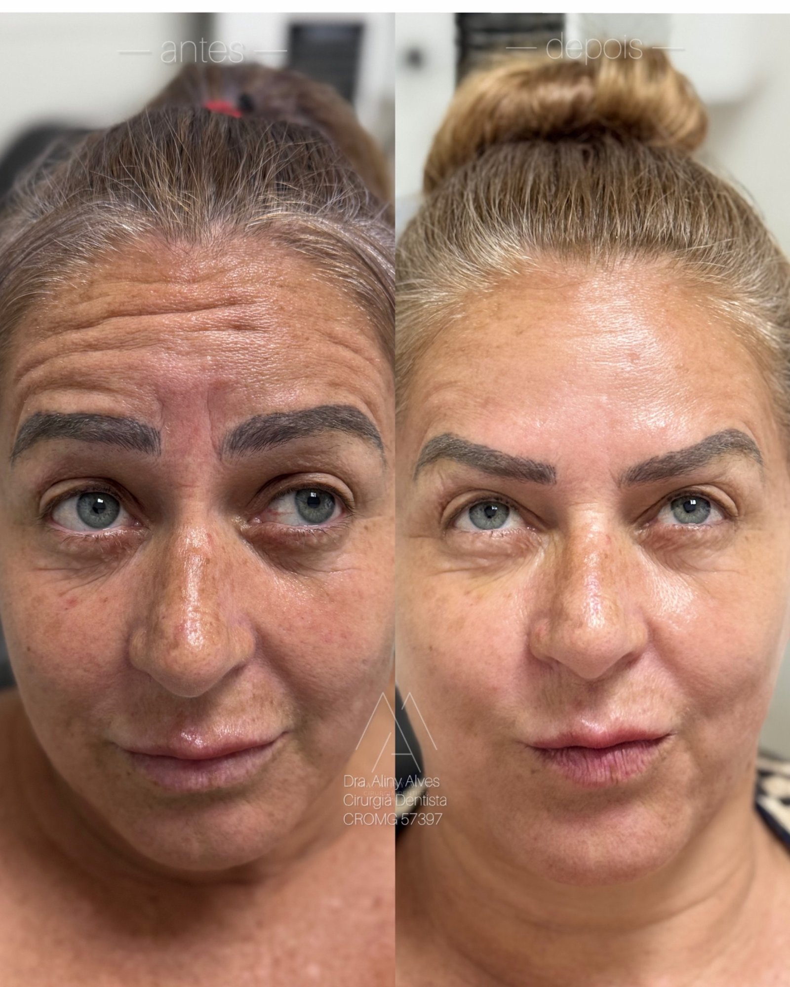 Toxina botulínica