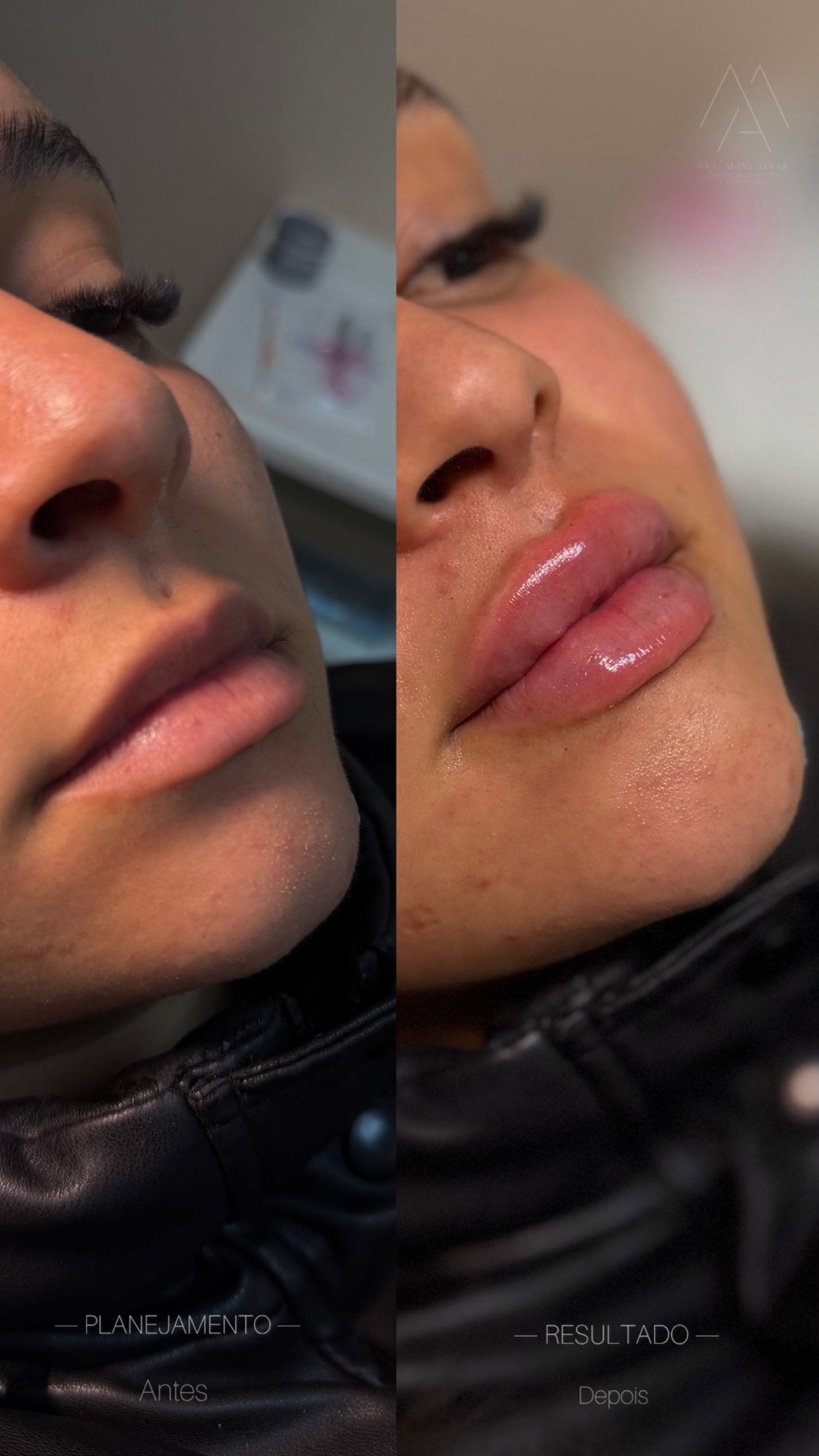 Preenchimento labial