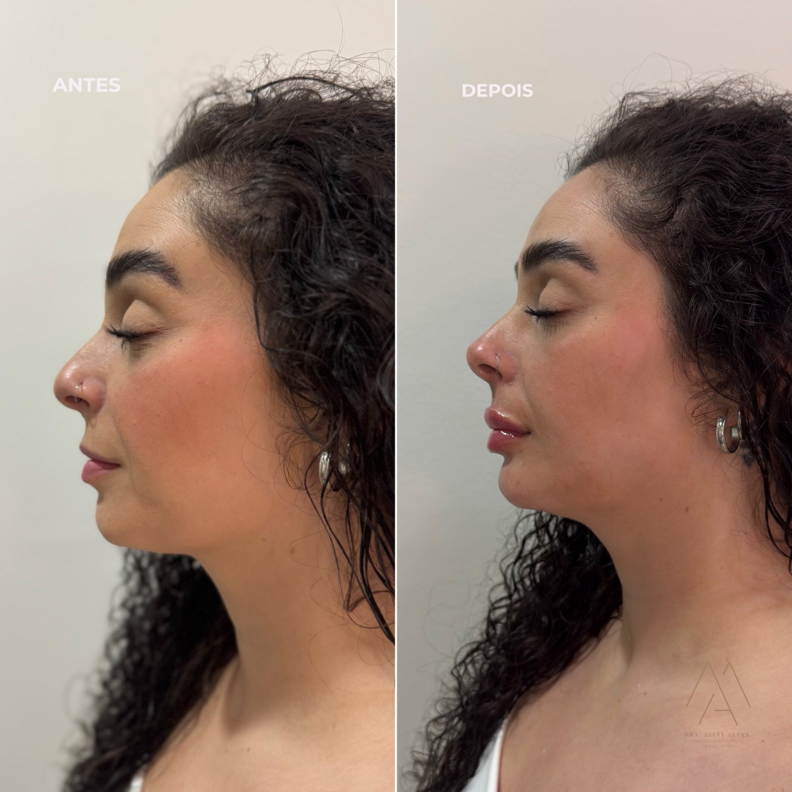 Perfiloplastia full face. Preenchimento labial, Rinomodelação e preenchimento de mento