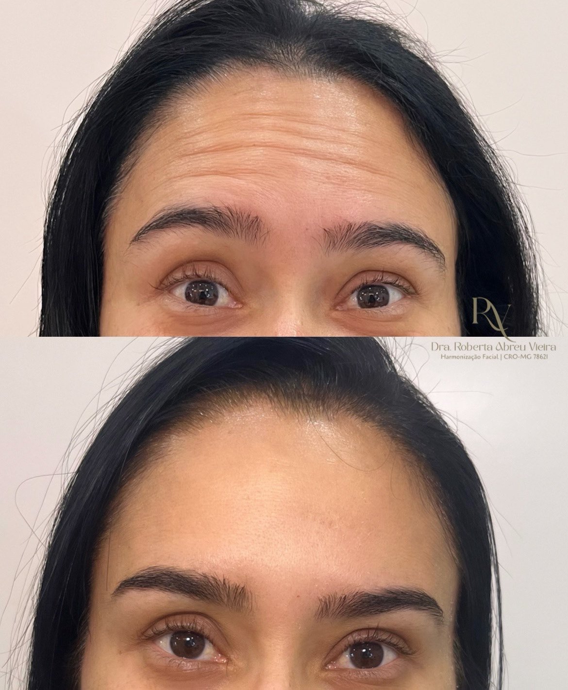 Suaviza as linhas de expressão, prevenindo marcas profundas e proporcionando uma aparência mais leve e natural, respeitando cada rosto.
